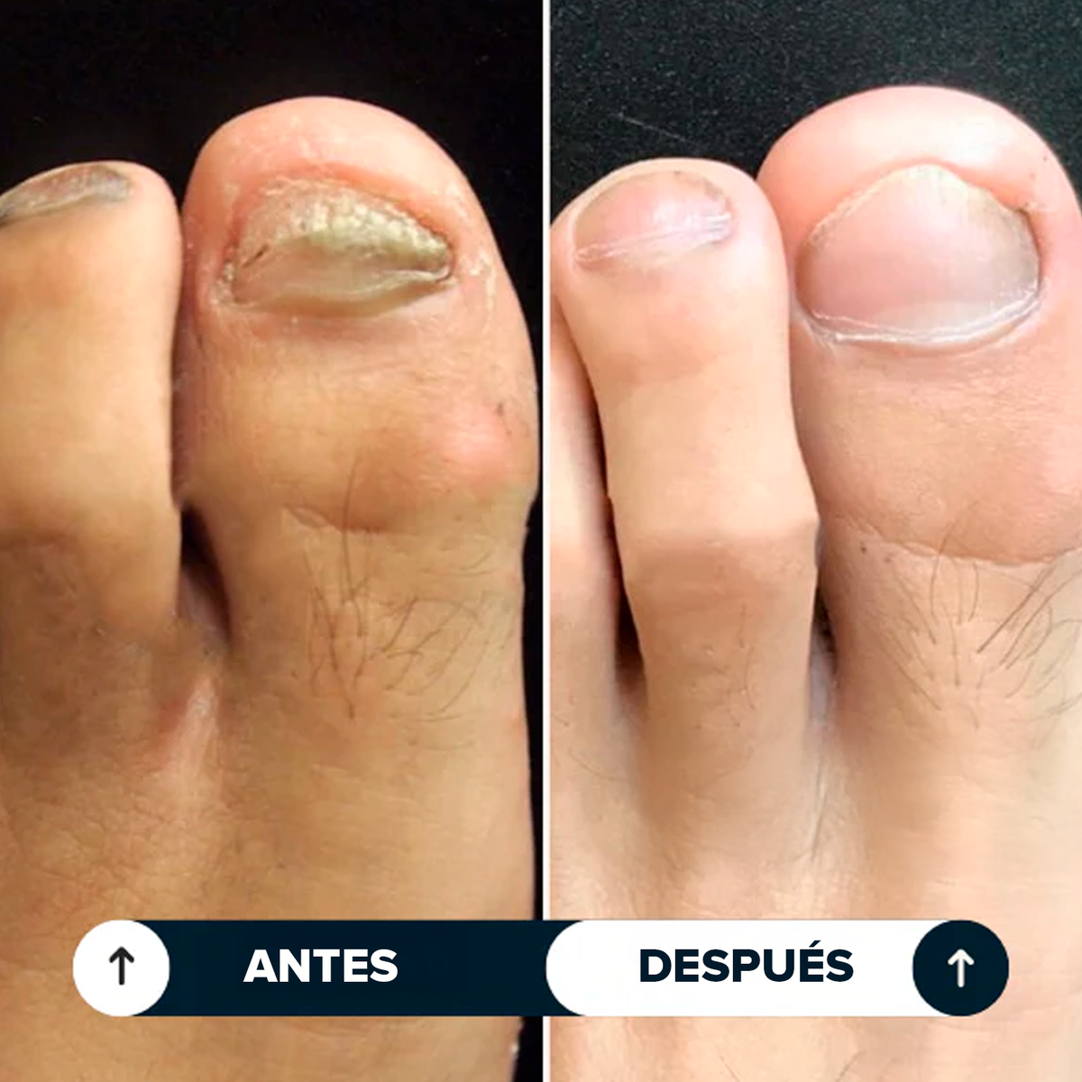 Lunavia™ Lápiz Antihongos