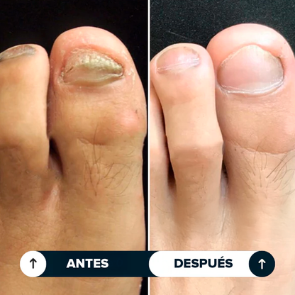 Lunavia™ Lápiz Antihongos