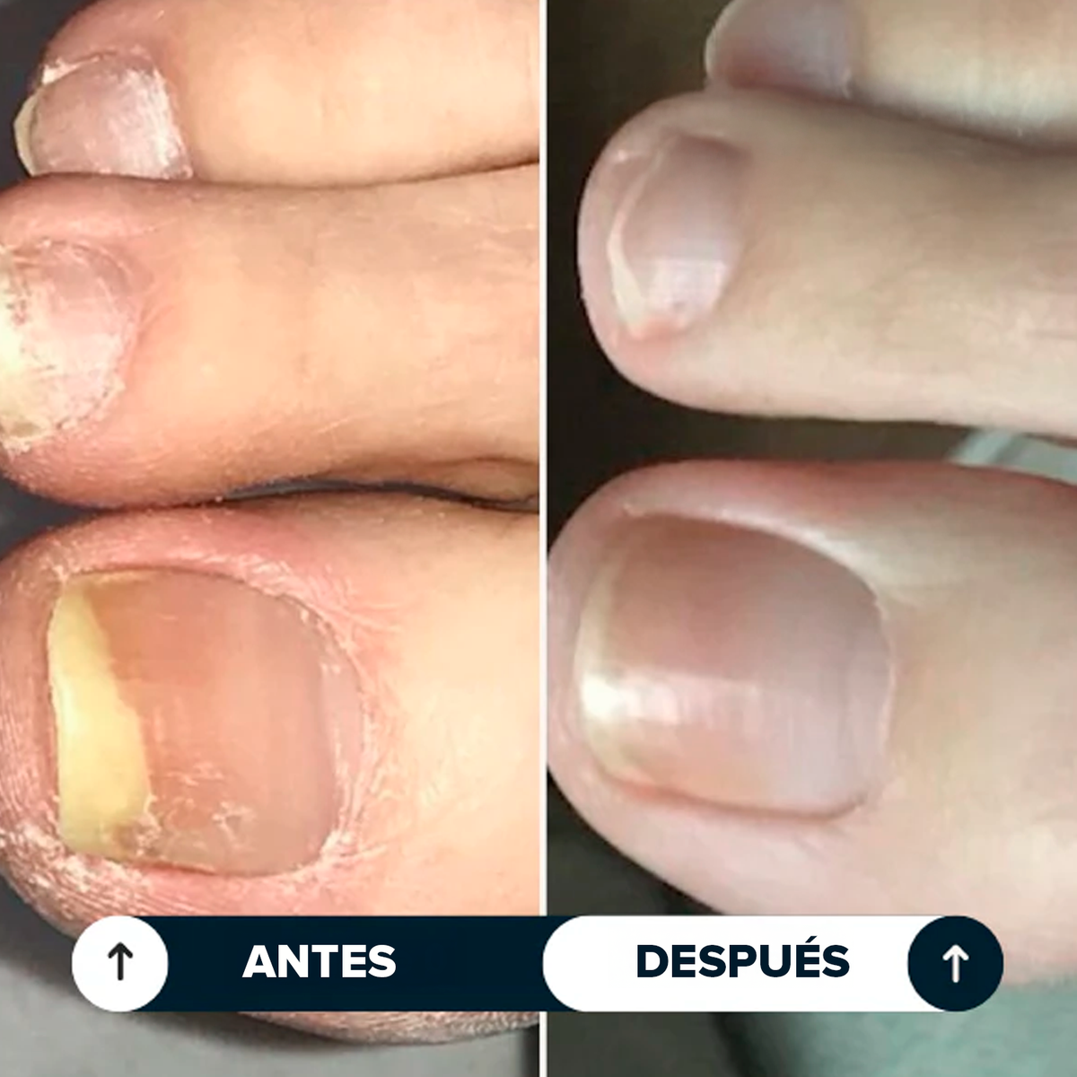 Lunavia™ Lápiz Antihongos
